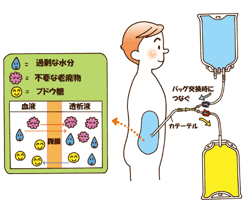 腹膜透析の仕組みと種類 腹膜透析 治療法について 腎臓病について 一般社団法人 全国腎臓病協議会 全腎協