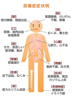 悪く 腎臓 なると が 【医師が教える】腎臓が悪いと言われたらまず読んでほしい記事